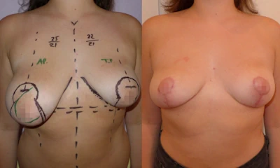 Foto Mastopessi seno asimmetrico prima e dopo