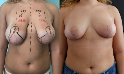 Foto Mastopessi seno tuberoso prima e dopo