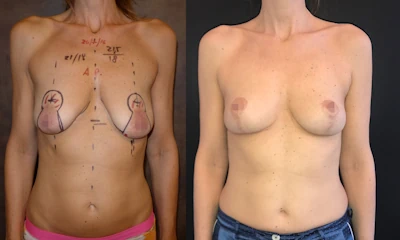 Foto Mastopessi con auto-protesi prima e dopo