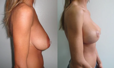 Foto Mastopessi additiva prima e dopo