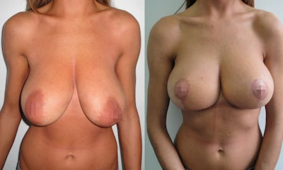 Foto Mastopessi additiva prima e dopo
