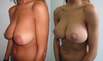 Foto Mastopessi additiva prima e dopo