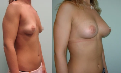 Foto seno rifatto taglia 3ª prima e dopo