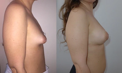 Seno tuberoso rifatto taglia 2ª