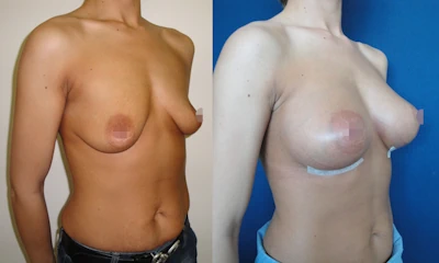 Foto seno rifatto taglia 4ª prima e dopo