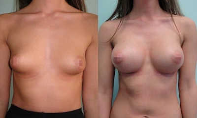 Foto seno tuberoso rifatto taglia 4ª prima e dopo