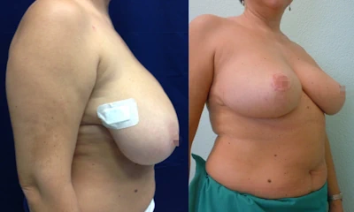 Foto Mastoplastica riduttiva prima e dopo