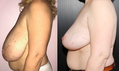 Foto Mastoplastica riduttiva prima e dopo