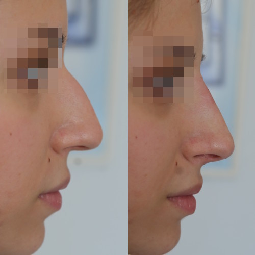 rinofiller-prima-e-dopo-0