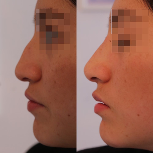 rinofiller-prima-e-dopo-1