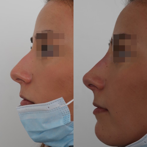 rinofiller-prima-e-dopo-10