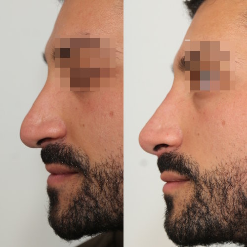 rinofiller-prima-e-dopo-11