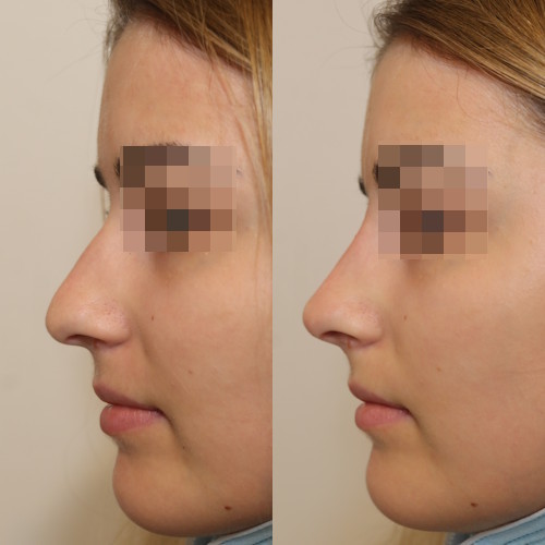 rinofiller-prima-e-dopo-12