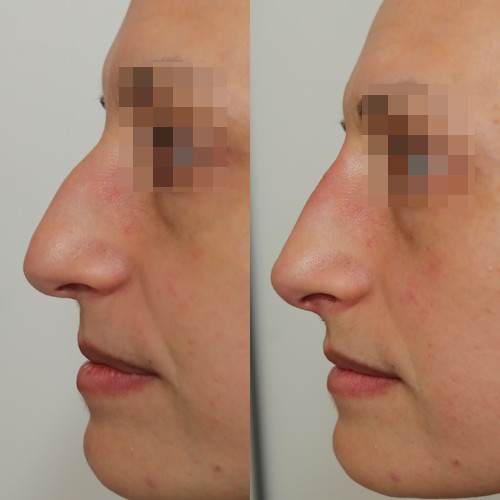 rinofiller-prima-e-dopo-13