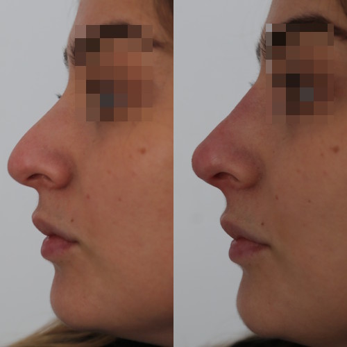 rinofiller-prima-e-dopo-14