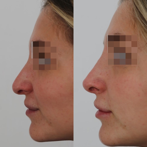 rinofiller-prima-e-dopo-15