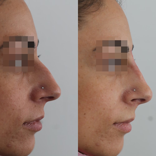 rinofiller-prima-e-dopo-16