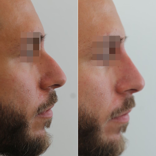 rinofiller-prima-e-dopo-17