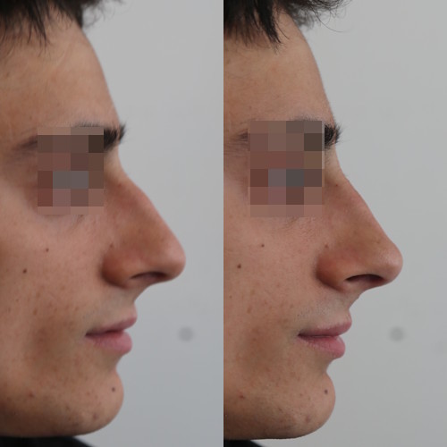 rinofiller-prima-e-dopo-18