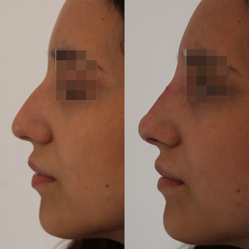 rinofiller-prima-e-dopo-19