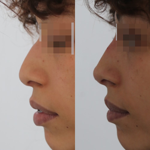 rinofiller-prima-e-dopo-2