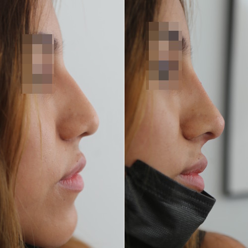 rinofiller-prima-e-dopo-20