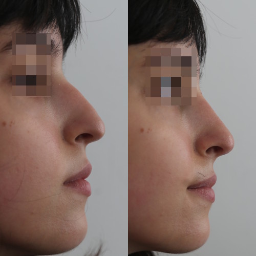 rinofiller-prima-e-dopo-21