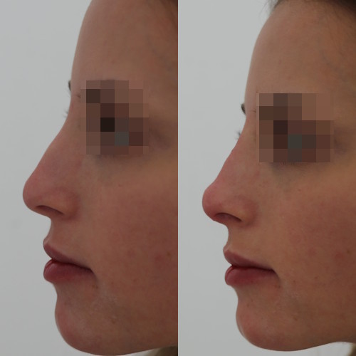 rinofiller-prima-e-dopo-22