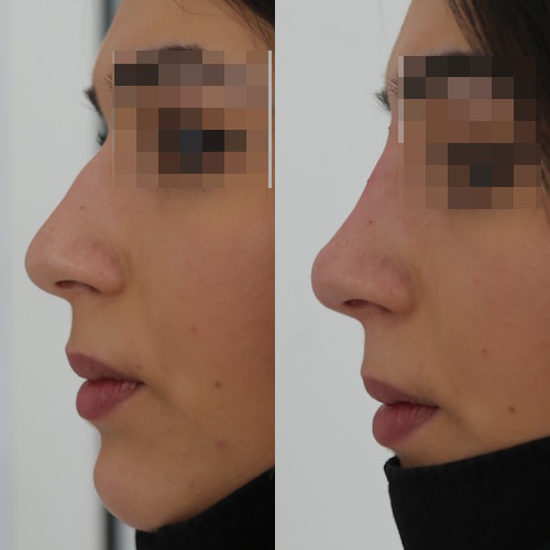 rinofiller-prima-e-dopo-3