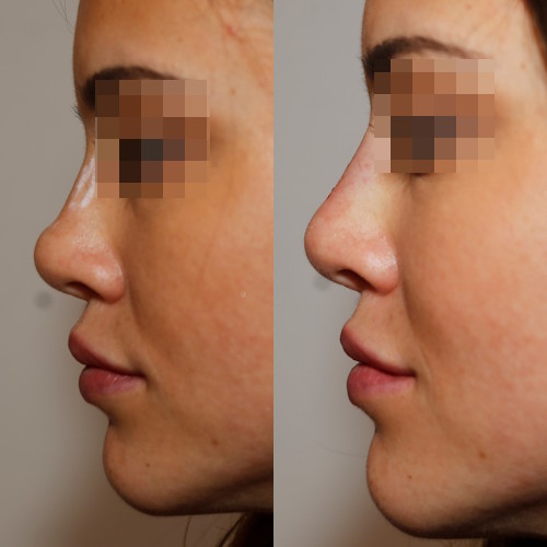 rinofiller-prima-e-dopo-4