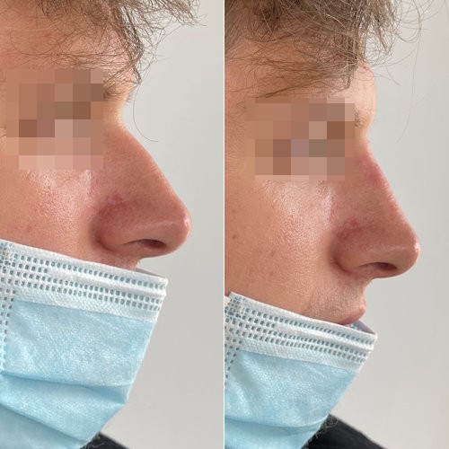 rinofiller-prima-e-dopo-5