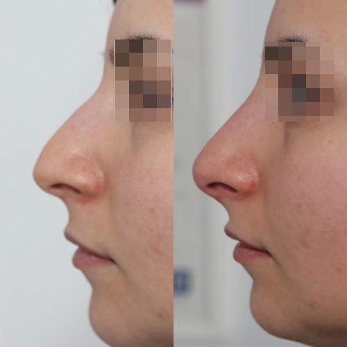 rinofiller-prima-e-dopo-6