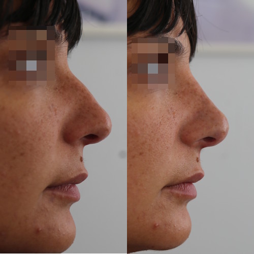 rinofiller-prima-e-dopo-7