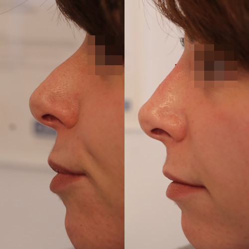 rinofiller-prima-e-dopo-8