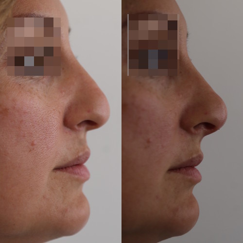 rinofiller-prima-e-dopo-9